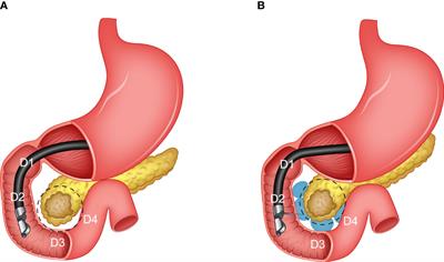 Finite Element-Based Personalized Simulation of Duodenal Hydrogel Spacer: Spacer Location Dependent Duodenal Sparing and a Decision Support System for Spacer-Enabled Pancreatic Cancer Radiation Therapy